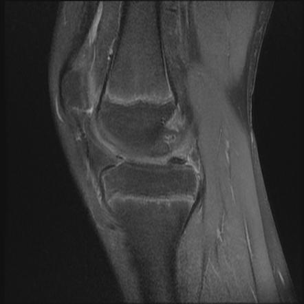 Osteochondritis dissecans of the medial femoral condyle with a MCL tear ...