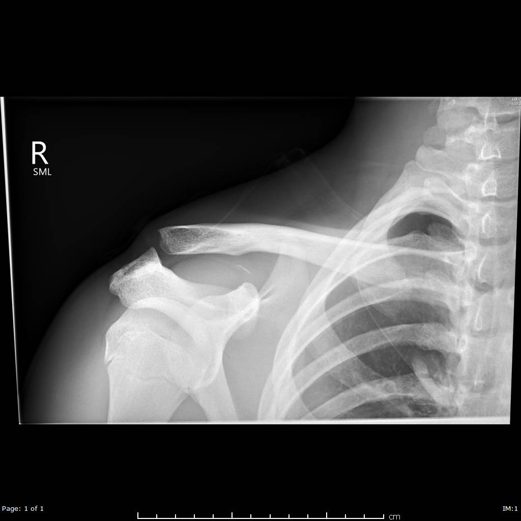 Rockwood Ii Acromioclavicular Joint Injury With Coracoid Process Avulsion Fracture Image