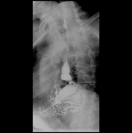 Cricopharyngeal Muscle Spasm And Mixed Hiatus Hernia Image Radiopaedia Org