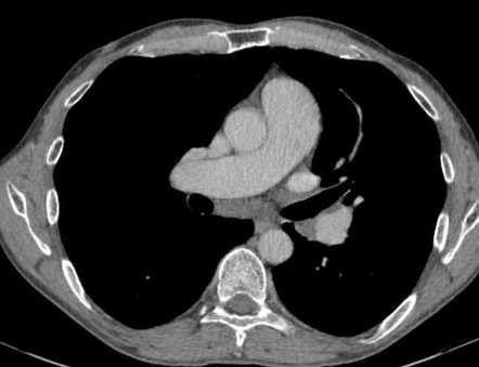 Lymphocytic interstitial pneumonitis | Radiology Case | Radiopaedia.org