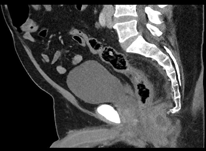 Horseshoe perianal abscess | Image | Radiopaedia.org