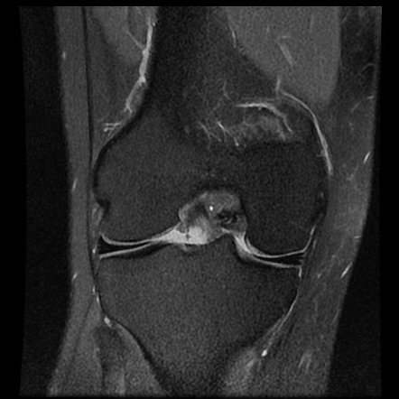 Anterior cruciate ligament tear | Radiology Case | Radiopaedia.org