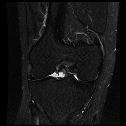 Anterior cruciate ligament tear | Image | Radiopaedia.org