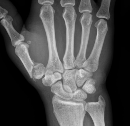 Epibasal fracture of the thumb | Radiology Reference Article ...