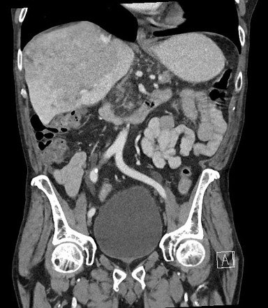 Infiltrative hepatocellular carcinoma (HCC) | Image | Radiopaedia.org