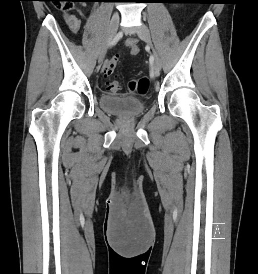 Complicated inguinal hernia repair - scrotal abscess | Image ...