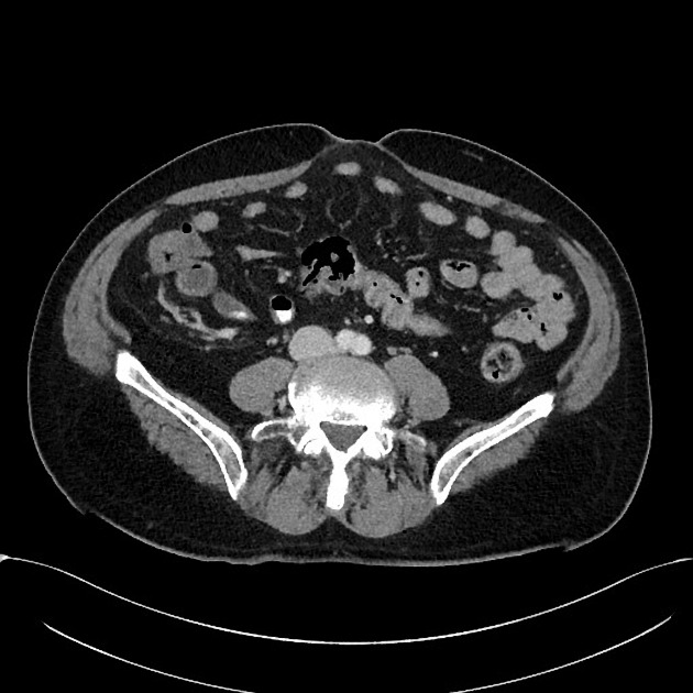 Featured image of post Appendicitis Ct Radiopaedia Appendicitis causes extreme abdominal pain