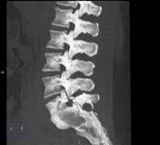 Spondylolysis X Ray