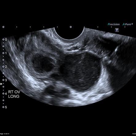 Endometriomas | Radiology Case | Radiopaedia.org