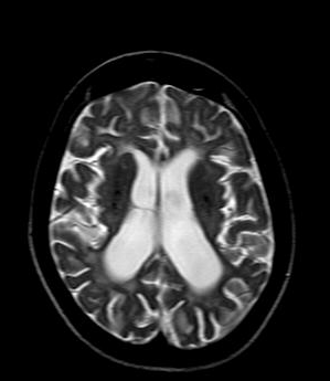 Cockayne syndrome | Image | Radiopaedia.org