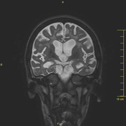 Cockayne Syndrome | Image | Radiopaedia.org