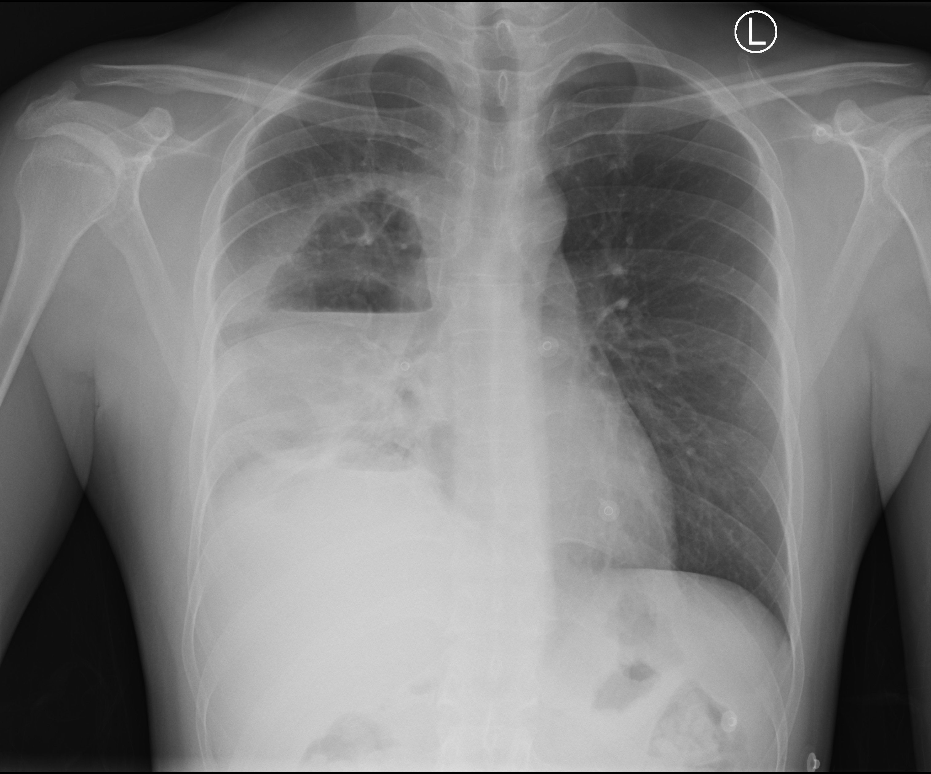 Primary pulmonary large B-cell lymphoma - cavitating lesions | Image ...