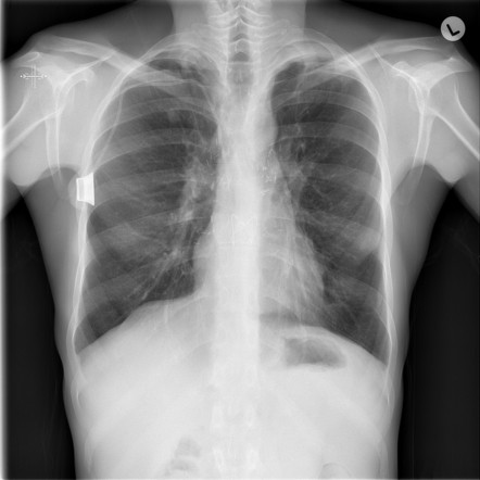 Pulmonary cryptococcosis - lung transplant | Radiology Case ...