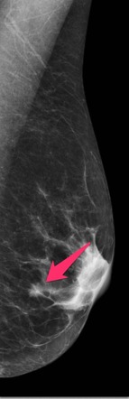 Tubular carcinoma of the breast, Radiology Reference Article