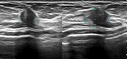 Tubular Carcinoma Of The Breast Radiology Reference Article Radiopaedia Org