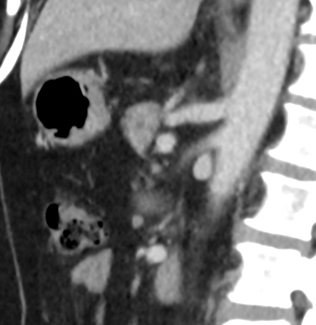 Intraductal Papillary Mucinous Neoplasm - Large | Image | Radiopaedia.org