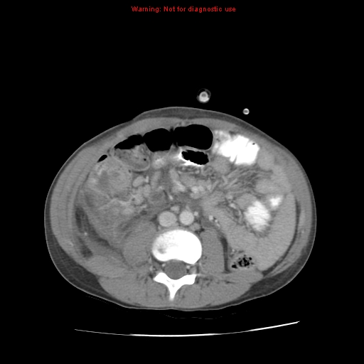 Appendicitis with phlegmon | Image | Radiopaedia.org