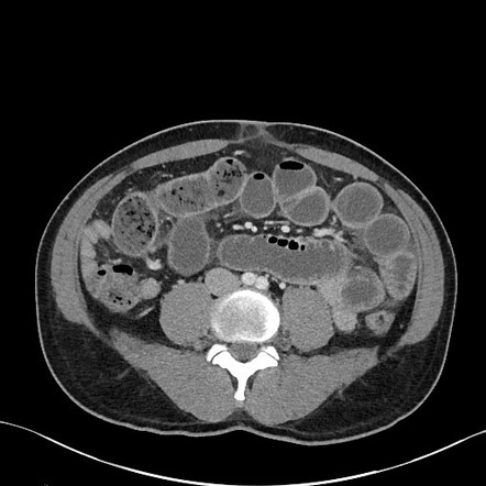 Small bowel feces sign | Radiology Reference Article | Radiopaedia.org