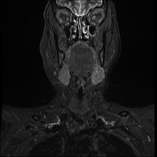 Chronic Submandibular Sialadenitis Image