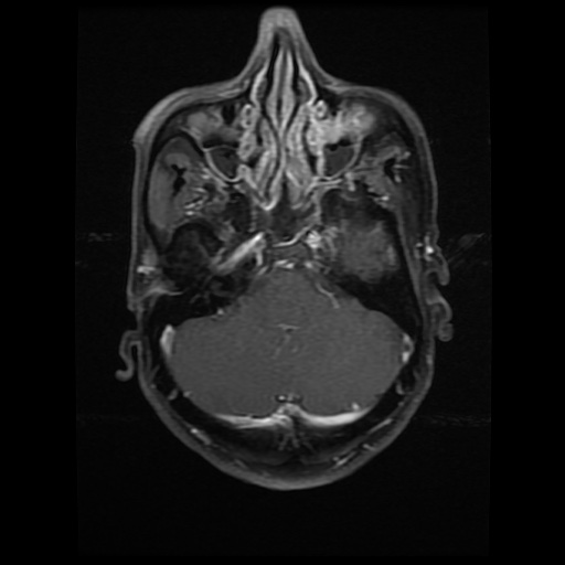 Sigmoid Sinus Thrombosis Image