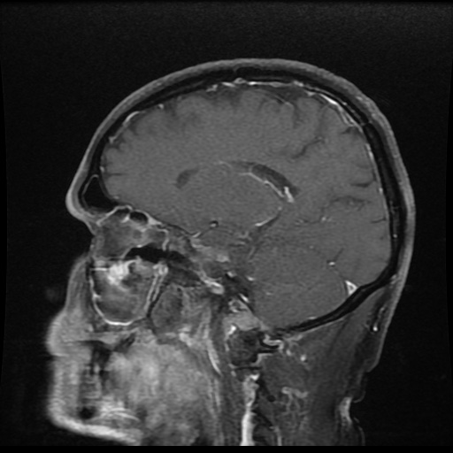 Sigmoid Sinus Thrombosis Image