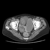 Krukenberg tumor | Radiology Reference Article | Radiopaedia.org