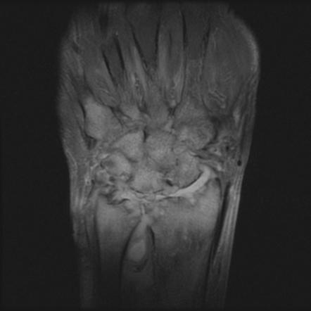 Rheumatoid Arthritis Musculoskeletal Manifestations Radiology Reference Article