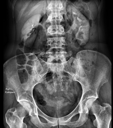 Ureterocele - cobra head sign | Image | Radiopaedia.org