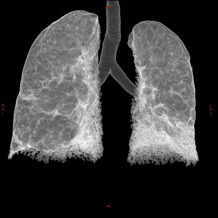 Usual interstitial pneumonia | Radiology Reference Article ...