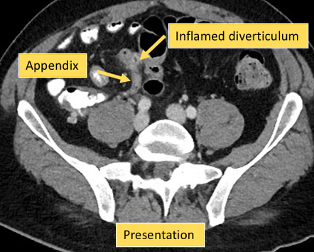 Image | Radiopaedia.org