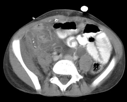 Appendicitis with phlegmon | Image | Radiopaedia.org