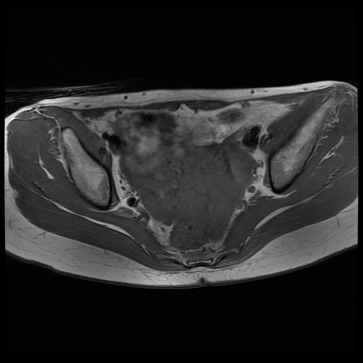 Normal Female Pelvis Mri Retroverted Uterus Image Radiopaedia Org