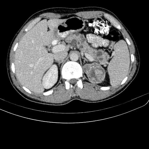 Von Hippel-Lindau disease | Image | Radiopaedia.org