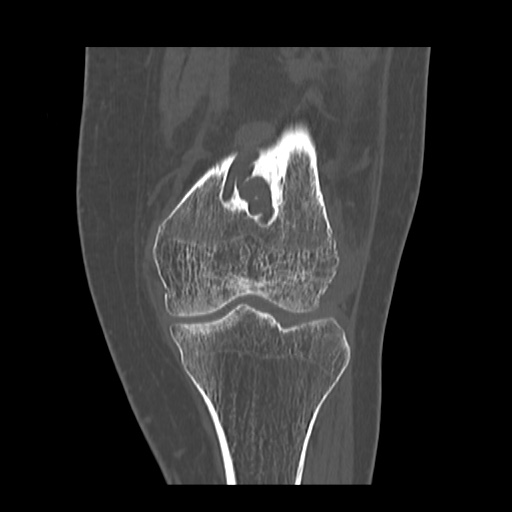 Popliteal arteriovenous malformation | Image | Radiopaedia.org