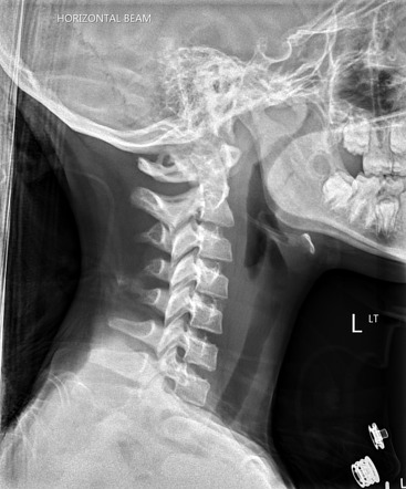 Adenoidal hypertrophy | Radiology Case | Radiopaedia.org