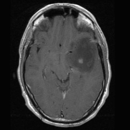 Diffuse astrocytoma NOS (