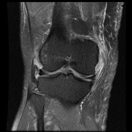 Medial collateral ligament tear | Radiology Case | Radiopaedia.org