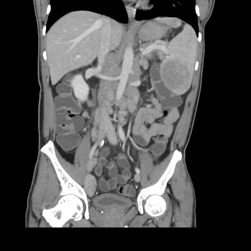 Poland syndrome and lymphoproliferative disease | Image | Radiopaedia.org