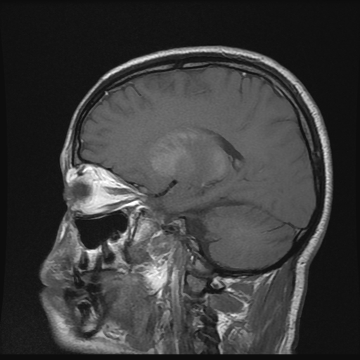 Progressive striopallidodentate calcinosis (Fahr disease) | Image ...