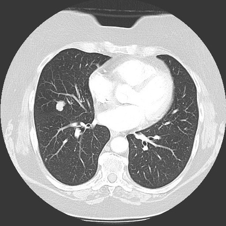 Carcinoid Tumor Lung Cancer