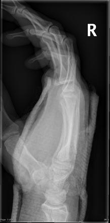 5th carpometacarpal joint dislocation | Image | Radiopaedia.org