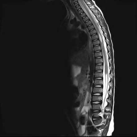 Caudal regression syndrome | Radiology Reference Article | Radiopaedia.org