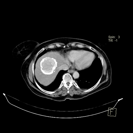 Calcified hydatid cyst | Radiology Case | Radiopaedia.org