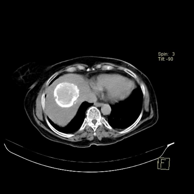 Calcified hydatid cyst | Image | Radiopaedia.org