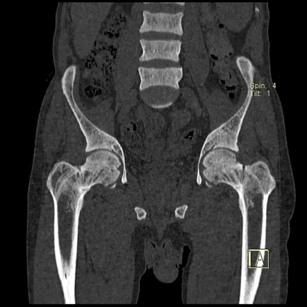 Renal Osteodystrophy And Insufficiency Fractures 