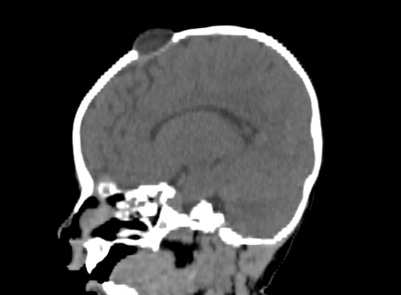 fontanelle cyst radiopaedia