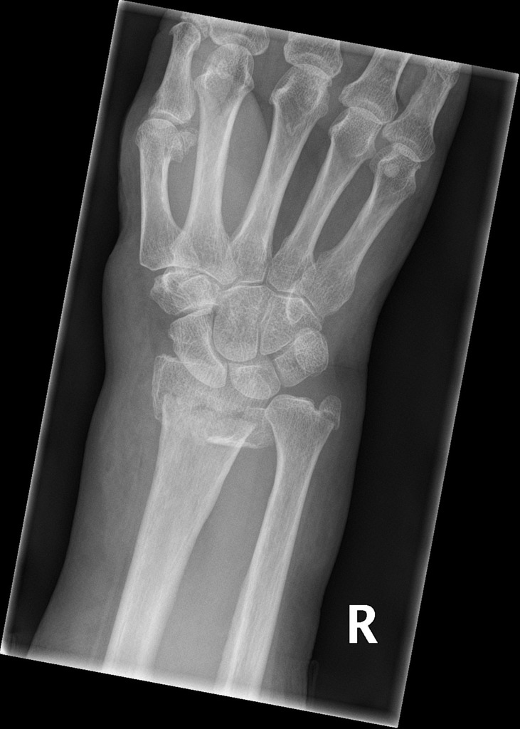 Intra Articular Fracture slidesharedocs