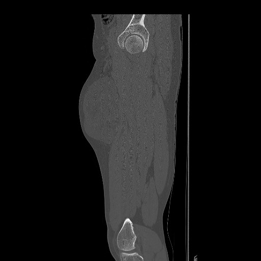 Myxoid liposarcoma - thigh anterior compartment | Image | Radiopaedia.org