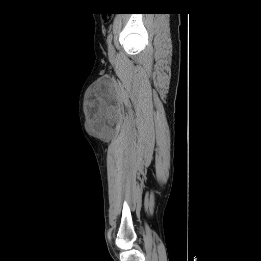 Myxoid liposarcoma - thigh anterior compartment | Image | Radiopaedia.org