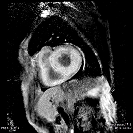 Cardiac amyloidosis | Image | Radiopaedia.org